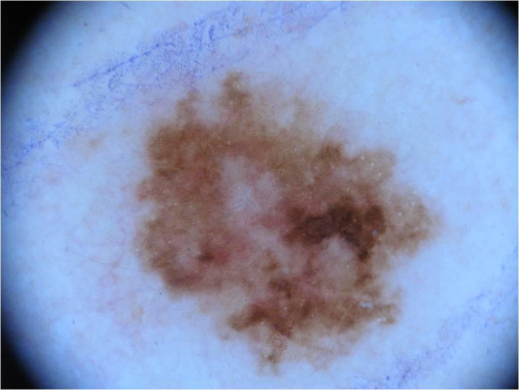 Imagem dermatoscópica real